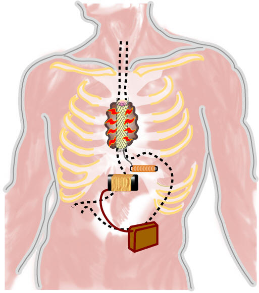 hyperthermia treatment